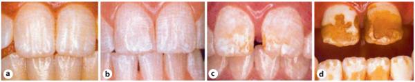 Chronic Exposure of Fluoride Leads to Dental Fluorosis